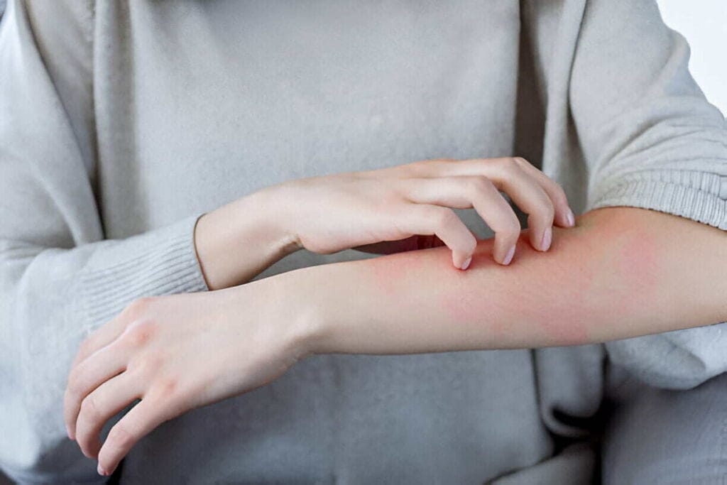 skin-allergy